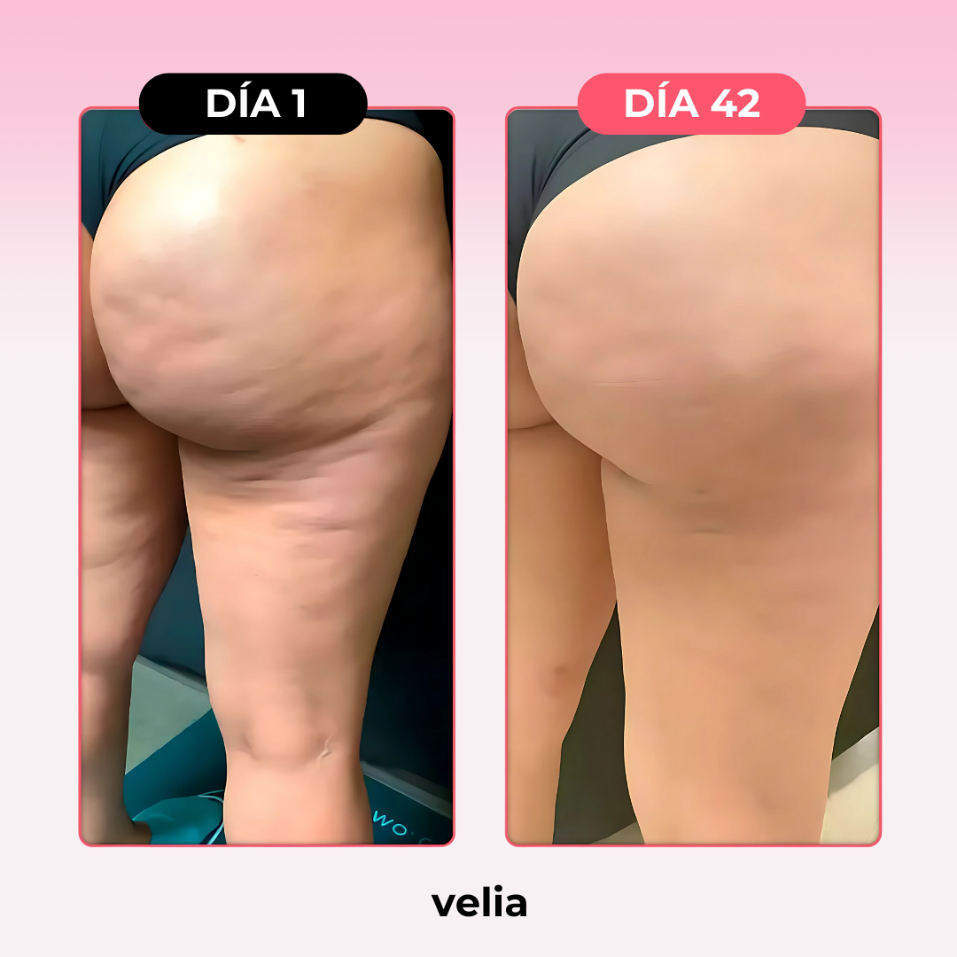 Kit Velia Pro® Elimina Celulitis y Grasa Localizada en 21 días