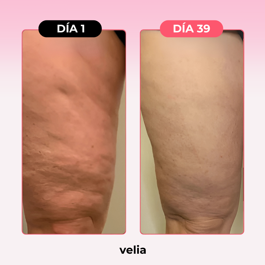 Kit Velia Pro® Elimina Celulitis y Grasa Localizada en 21 días